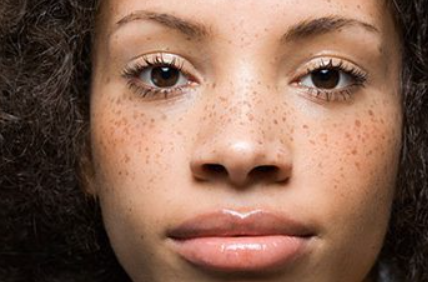 10 Ways How to treat freckles on the face?